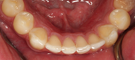 Before and After Invisalign Treatment Milton Keynes Before and After Invisalign Treatment Milton Keynes