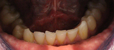 Before and After Invisalign Treatment Milton Keynes Before and After Invisalign Treatment Milton Keynes