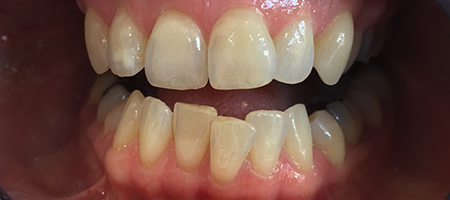 Before and After Invisalign Treatment Milton Keynes Before and After Invisalign Treatment Milton Keynes