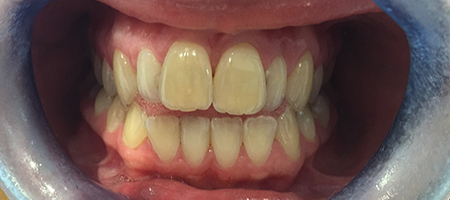 Before and After Invisalign Treatment Milton Keynes Before and After Invisalign Treatment Milton Keynes