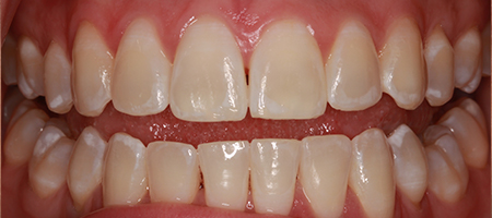 Before and After Invisalign Treatment Milton Keynes Before and After Invisalign Treatment Milton Keynes