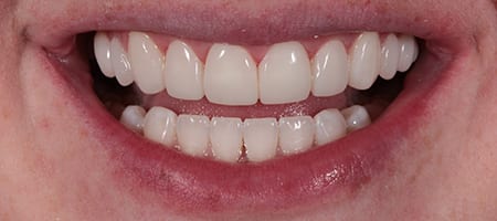 After Invisalign Treatment Reading Smiles