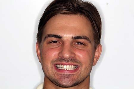 Before and After Invisalign Treatment Milton Keynes Before and After Invisalign Treatment Milton Keynes