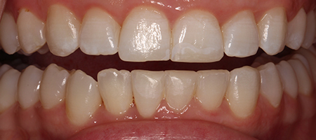 Before and After Invisalign Treatment Milton Keynes Before and After Invisalign Treatment Milton Keynes