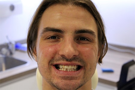 Before and After Invisalign Treatment Milton Keynes Before and After Invisalign Treatment Milton Keynes