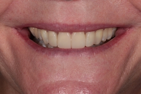 Before and After Invisalign Treatment Milton Keynes