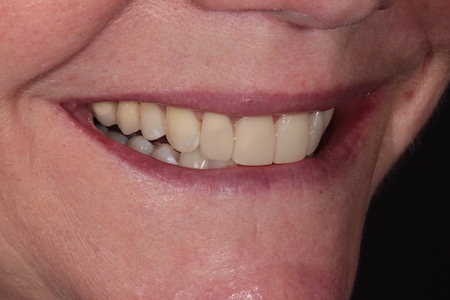 Before and After Invisalign Treatment Milton Keynes