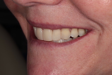 Before and After Invisalign Treatment Milton Keynes