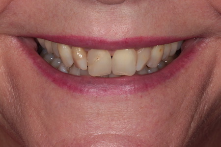 Before and After Invisalign Treatment Milton Keynes