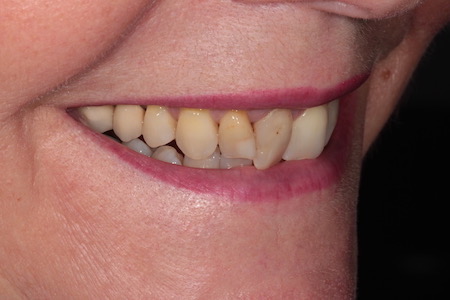 Before and After Invisalign Treatment Milton Keynes