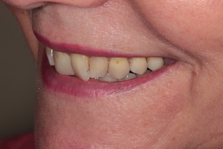 Before and After Invisalign Treatment Milton Keynes