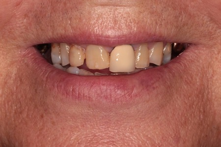 Before and After Invisalign Treatment Milton Keynes