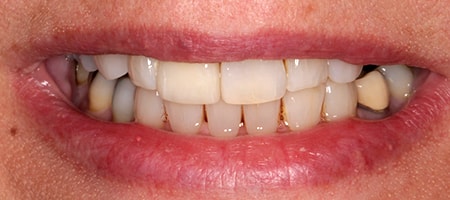 Before and After Invisalign Treatment Milton Keynes