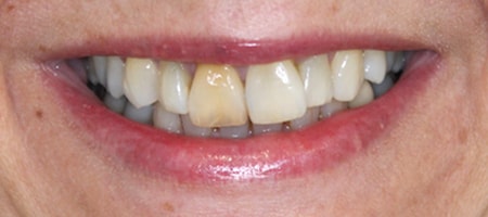 Before and After Invisalign Treatment Milton Keynes