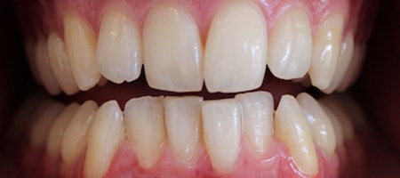 Before and After Invisalign Treatment Milton Keynes Before and After Invisalign Treatment Milton Keynes