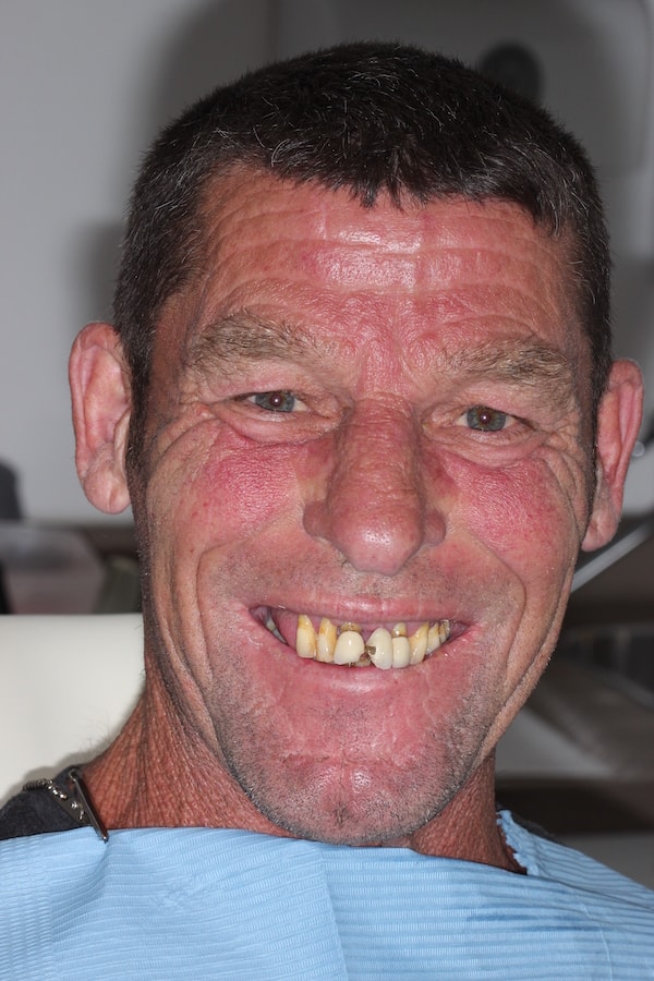 Before and After Implants Treatment Milton Keynes