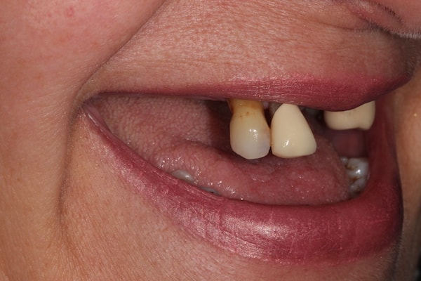Before and After Implants Treatment Milton Keynes
