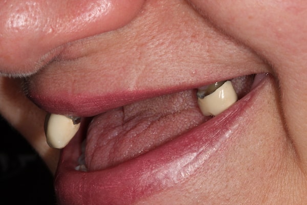 Before and After Implants Treatment Milton Keynes
