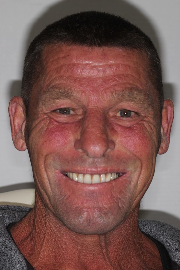 Before and After Implants Treatment Milton Keynes