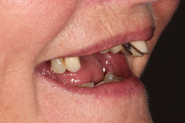 Before and After Implants Treatment Milton Keynes