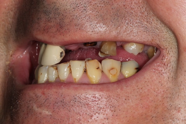 Before and After Implants Treatment Milton Keynes