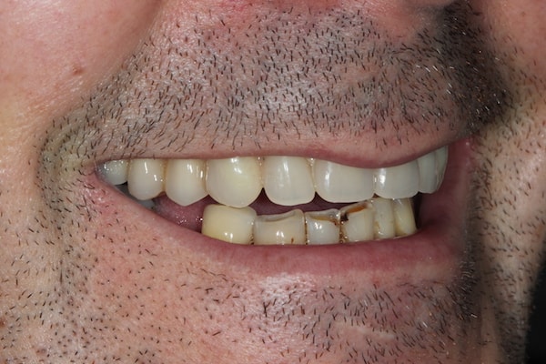 Before and After Implants Treatment Milton Keynes