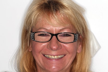 Before and After Invisalign Treatment Milton Keynes