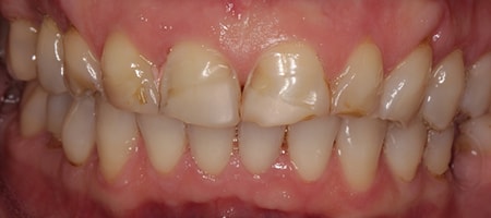 Before and After Invisalign Treatment Milton Keynes