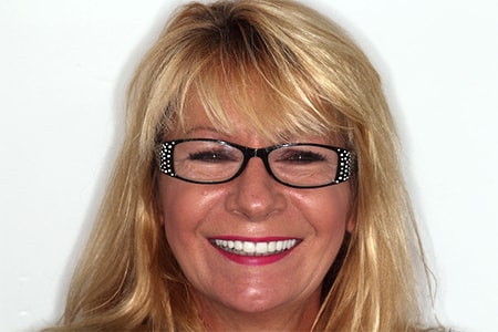 Before and After Invisalign Treatment Milton Keynes