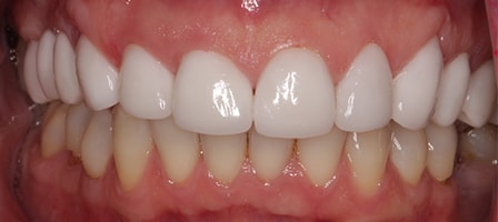 Before and After Invisalign Treatment Milton Keynes