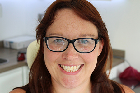 Before and After Invisalign Treatment Milton Keynes Before and After Invisalign Treatment Milton Keynes