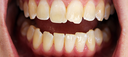Before and After Invisalign Treatment Milton Keynes Before and After Invisalign Treatment Milton Keynes