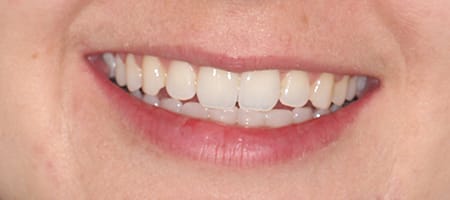 Before and After Invisalign Treatment Milton Keynes Before and After Invisalign Treatment Milton Keynes
