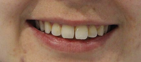 Before and After Invisalign Treatment Milton Keynes Before and After Invisalign Treatment Milton Keynes