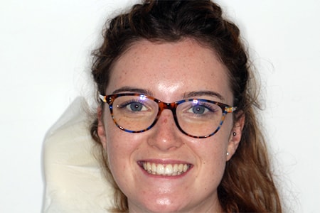 Before and After Invisalign Treatment Milton Keynes Before and After Invisalign Treatment Milton Keynes