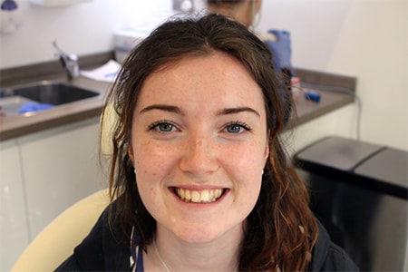 Before and After Invisalign Treatment Milton Keynes Before and After Invisalign Treatment Milton Keynes