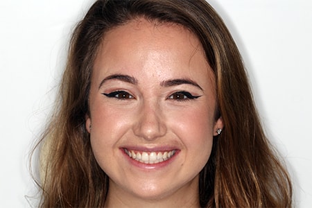 Before and After Invisalign Treatment Milton Keynes Before and After Invisalign Treatment Milton Keynes