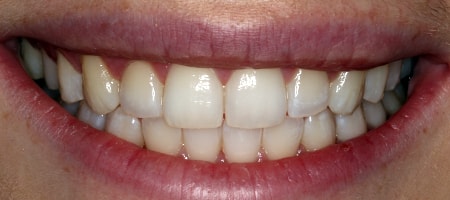 After Invisalign Treatment Milton Keynes After Invisalign Treatment Milton Keynes