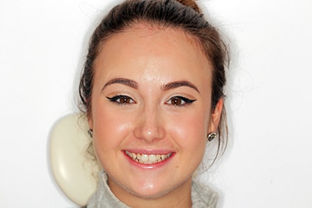 Before and After Invisalign Treatment Milton Keynes Before and After Invisalign Treatment Milton Keynes