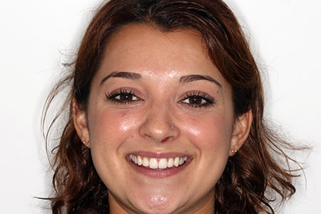 Before and After Invisalign Treatment Milton Keynes Before and After Invisalign Treatment Milton Keynes