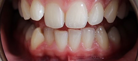 Before and After Invisalign Treatment Milton Keynes Before and After Invisalign Treatment Milton Keynes