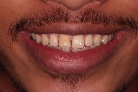 Before and After Invisalign Treatment Milton Keynes
