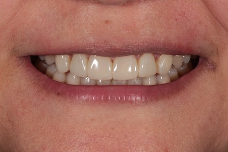 Before and After Invisalign Treatment Milton Keynes