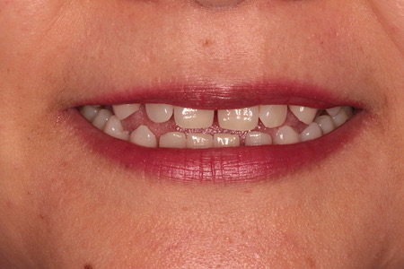 Before and After Invisalign Treatment Milton Keynes