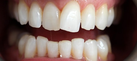 Before and After Invisalign Treatment Milton Keynes Before and After Invisalign Treatment Milton Keynes