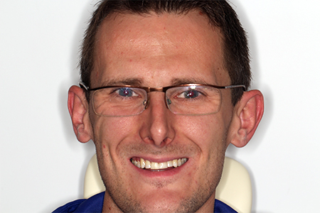 Before and After Invisalign Treatment Milton Keynes Before and After Invisalign Treatment Milton Keynes