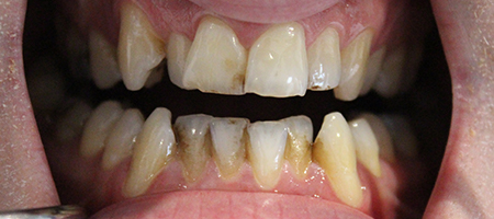 Before and After Invisalign Treatment Milton Keynes Before and After Invisalign Treatment Milton Keynes