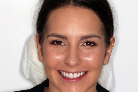 Before and After Invisalign Treatment Milton Keynes Before and After Invisalign Treatment Milton Keynes