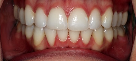 Before and After Invisalign Treatment Milton Keynes Before and After Invisalign Treatment Milton Keynes