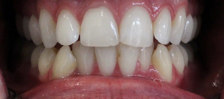 Before and After Invisalign Treatment Milton Keynes Before and After Invisalign Treatment Milton Keynes